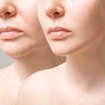 What Are the Signs You Might Be a Good Candidate for a Lip Lift?
